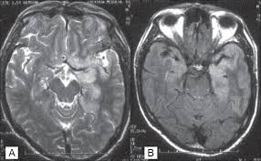 Herpes simplex virus (hsv) encephalitis hsv encephalitis (hsve) is the hsv1 encephalitis should always be considered on initial mri. Herpes Simplex Encephalitis In A Patient Having Common Variable Immuno Deficiency Ansari M K Jha S Ann Trop Med Public Health