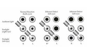 Perrla Eyes Examination What It Is And How It Is Done