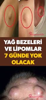 Yag Bezeleri Ve Lipomlar Icin Dogal Tedavi Yontemi Dogal Tedaviler Saglik Ve Fitness Saglik Ipuclari