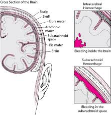 La différenciation entre l'avc ischémique et l'avc hémorragique au stade précoce est cruciale pour la prise de décision relative au traitement de l'avc. Hemorragie Intracerebrale Troubles Du Cerveau De La Moelle Epiniere Et Des Nerfs Manuels Msd Pour Le Grand Public