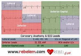 Anterior Myocardial Infarction - Wikidoc