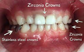 A #cavity is a small dental infection of the tooth that is comprised of bacteria and is treated with a #filling. Faq What Are The Different Ways You Can Fix My Child S Cavities Shelby Pediatric Dentistry Dental Care For Kids Birmingham Al