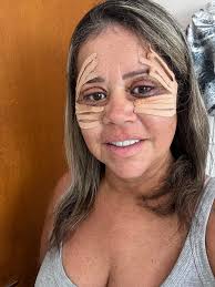 Voltando hoje pra mostrar a evolução da Blefaro 🥰 4º dia os roxos  diminuíram 80% Pós super tranquilo, fazendo compressas de soro fisiológico  e chá de camomila e pingando colírios , Impecável