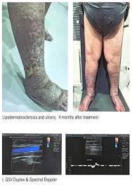 Image result for Lipodermatosclerosis