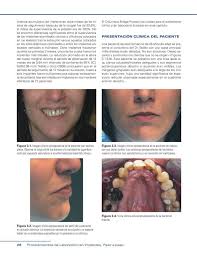 Procedimientos de Laboratorio en Implantes Paso a Paso
