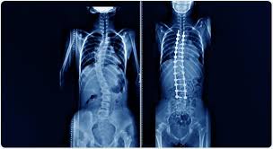 Marfan Syndrome Treatment