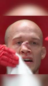 💀 NASTY broken nose Urijah Faber's A1 Combat… RESPECT to the fighter Blake  Perry who wanted to continue fighting!