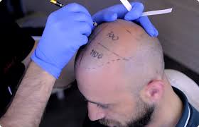 Image result for saç ekimi