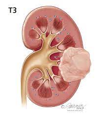 Specifically, a carcinoma is a cancer that begins in a tissue that lines the inner or outer surfaces of the body, and that arises from cells originating in the endodermal, mesodermal or ectodermal germ layer during embryogenesis. Kidney Cancer Symptoms Diagnosis Treatment Urology Care Foundation