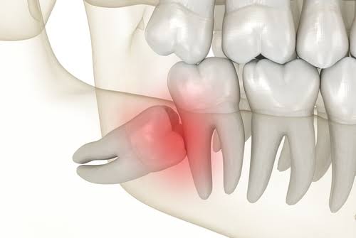 Why an Oral Surgeon, Not a General Practitioner, Should Handle Wisdom Tooth  Extractions | Dentist In Sherman Oaks, CA