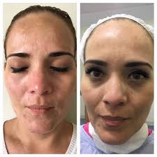 LÁSER FRAXEL DUAL!! ¿Problemas con las manchas? ¿ Cansad@ de ver tu rostro  opaco, con arrugas, marcas de acné y cicatrices? Ven con nosotros y  disfruta de nuestras promociones .. En tu