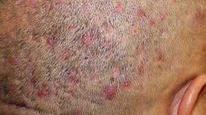Image result for folliculitis symptoms