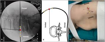 Be sure to call ahead with dr. Lateral Anterior Lumbar Interbody Fusion Lalif For Lumbar Degenerative Disease Technical Notes Surgical System And Mid Term Outcomes Abstract Europe Pmc