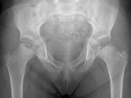Characteristic ultrastructural appearance of the glomerular intramembranous minimal change disease. Legg Calve Perthes Disease Radiology Case Radiopaedia Org
