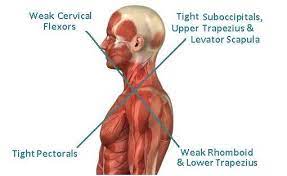 Upper Crossed Syndome