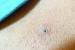 Ingrown Blackhead On Nose
