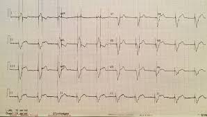 Figure 1 shows the ecg of a patient with an atrial pacemaker that was placed to address a problem in the sinoatrial (sa) node. Ecg Egm Challenge September 2018 Answer British Heart Rhythm Society