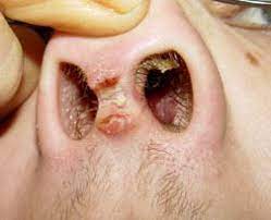 Septum Piercing Rejection Rate Migration Rejected Signs Through Cartilage And Pictures Septum Piercing Septum Piercing