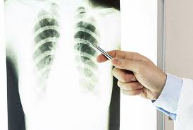 Image result for lung cancer xray