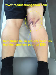 Connaître le temps nécessaire pour éliminer l'alcool est une donnée essentielle avant de prendre la route notamment après une soirée trop arrosée. Reeducationgenou Com Du 15e Jour Au 2e Mois Apres Plastie Du Lca