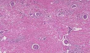 Inflammatory breast cancer is a rare but very aggressive type of breast cancer in which the cancer cells block the lymph vessels in the skin of the breast. Pathology Tests For Breast Cancer Information Myvmc