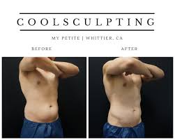 Identify how you will pay that bill. Coolsculpting Fat Freezing Your Ultimate Guide