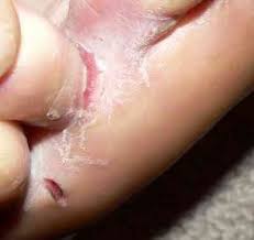 Left untreated, an infection could spread to other toenails, skin, or even your. Athlete S Foot Symptoms Treatment And Medication How To Avoid Patient
