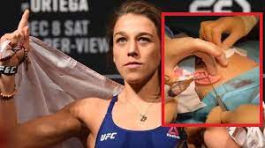 Joanna jędrzejczyk news from mmamania.com: Joanna Jedrzejczyk Shares Gruesome Video Of Cauliflower Ear Surgery