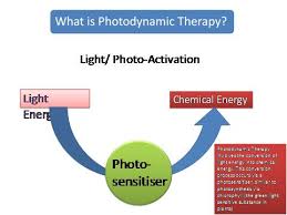 Pdt is currently not used in any location. Sonodynamic Photodynamic Therapy Canceractive