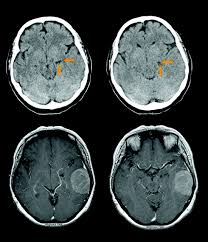 An Isodense On Ct Meningioma Practical Neurology