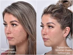 Hi there, i had filler in my under eye/cheek bone area and once this was settled i had threads put in. Thread Lift Sydney 1 Cosmetic Doctors Face Neck Cheek Lift Specialist Clinic