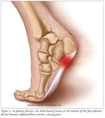 Image result for Foot Pain