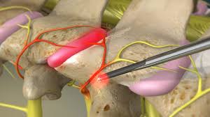 Facet syndrome is the result of an injury to the facet joints. Nevada Advanced Pain Cervical Facet Radiofrequency Neurotomy