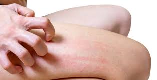 Pe palme,talpi si degete sunt sub forma unor basicute cu lichid grupate si tari (rar ma manaca). MancÄrimi Pe Picioare Èi Maini In Timpul Iernii Din Ce CauzÄ Apar Èi Care Sunt SoluÈiile