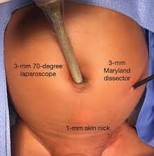 Image result for Inguinal hernia child