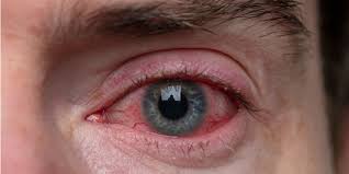 Urgent care near me merced, ca. Home Remedies For Bloodshot Eyes American Academy Of Ophthalmology
