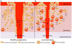 Your obstetric provider will talk with you about what type of delivery is right for your condition. Frontiers Monocytes And Macrophages In Pregnancy And Pre Eclampsia Immunology
