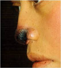 Reporte de un caso 166 rev. Cutaneous Zygomycosis Sciencedirect
