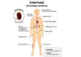 How To Identify High Cortisol Levels Cushing S Syndrome Saint John S Cancer Institute Blog