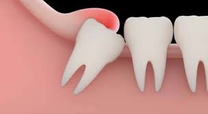 As the decay gets larger, it may cause signs and symptoms such as: Managing Wisdom Tooth Pain At Home Without Seeing A Dentist