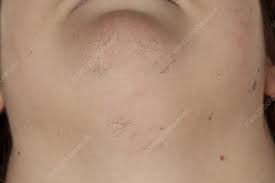 Unwanted facial fuzz on your upper lip, inside your nose or around your chin is actually a very common side effect of ageing. Excessive Female Facial Hair Growth Stock Image C029 6420 Science Photo Library