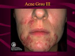 Suas esteticistas da web explicam sobre os graus de acne. Acne Ppt Carregar