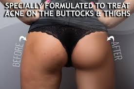 How to remove dark spots on face fast. Amazon Com Anti Acne Buttocks Thigh Treatment Clears Away Acne Pimples And Ingrown Hairs For The Buttocks And Thigh Area Prevents Future Breakouts Beauty
