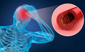 Blood clots can have several symptoms, although sometimes there are no obvious symptoms. Blood Clot In The Brain Symptoms To Look For Narayana Health