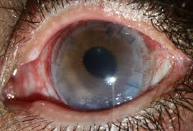 Acanthamoeba keratitis requires early diagnosis and treatment by an eye doctor to avoid vision loss. Contact Lens Related Visual Loss In The Context Of Microbial Keratitis Opto