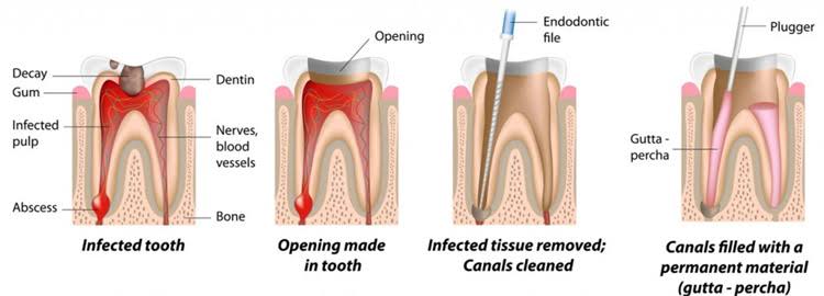 Root Canal Treatment product image