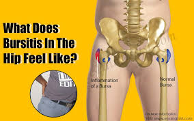 Pin On Bursitis Hip