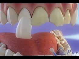 Comment est ce que cela se passe concrètement ? Facette Dentaire Preparation Et Mise En Place Des Facettes C Youtube