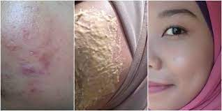 Tanaman herbal kini pun telah banyak hadir dalam kemasan siap saji dan juga digunakan pada industri obat. Petua Hilangkan Parut Jerawat Dalam Masa 7 Hari