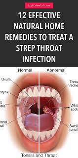 12 Effective Natural Home Remedies To Treat A Strep Throat Infection Natural Home Remedies Throat Infection Remedies